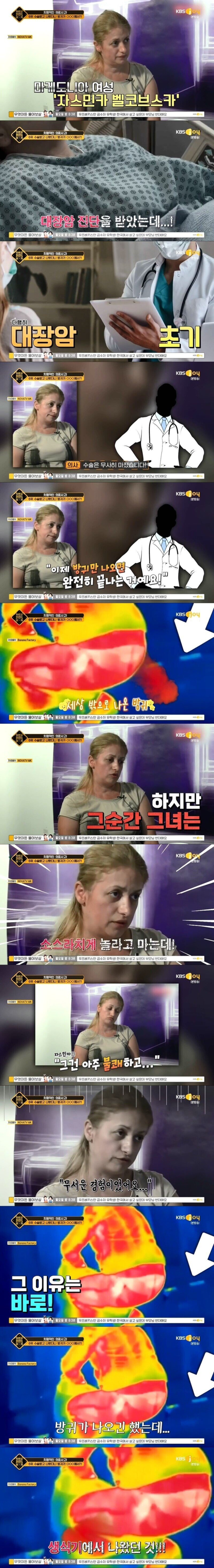 대장암 수술했더니 방귀가 생식기에서 나오는 여자