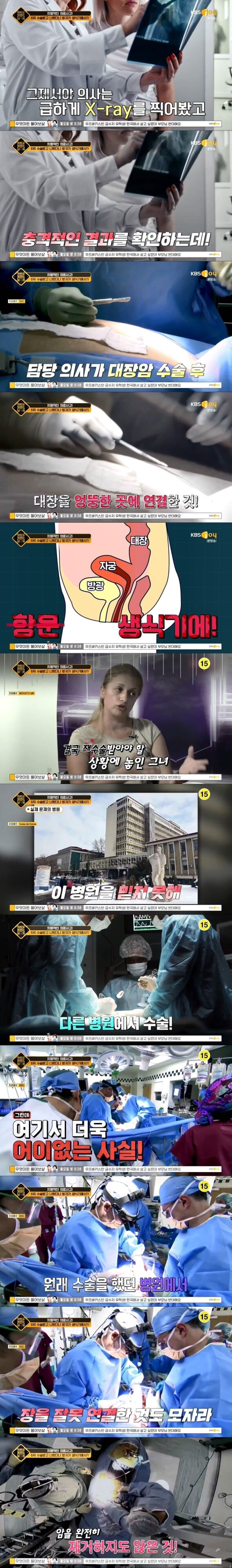 대장암 수술했더니 방귀가 생식기에서 나오는 여자