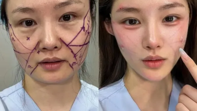 중국여자 성형 전 후