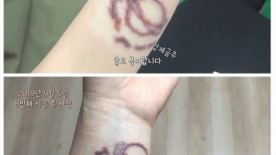 5년간의 타투 제거 후기