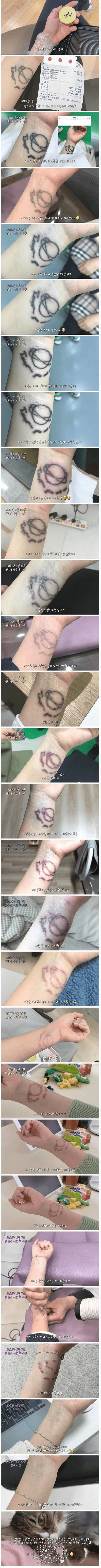 5년간의 타투 제거 후기