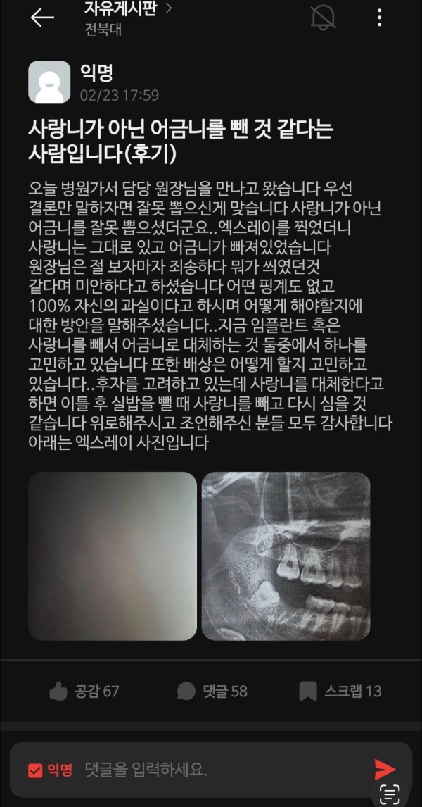 사랑니 대신 어금니 뽑힌 썰