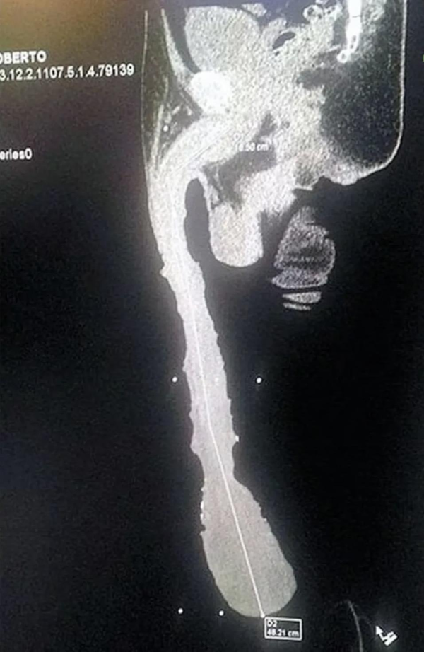 세상에서 가장 큰 꽈추형